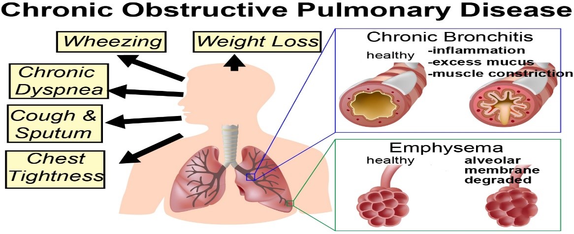 One of the best Chronic Obstructive Pulmonary disease (COPD) doctor in ahmedabad